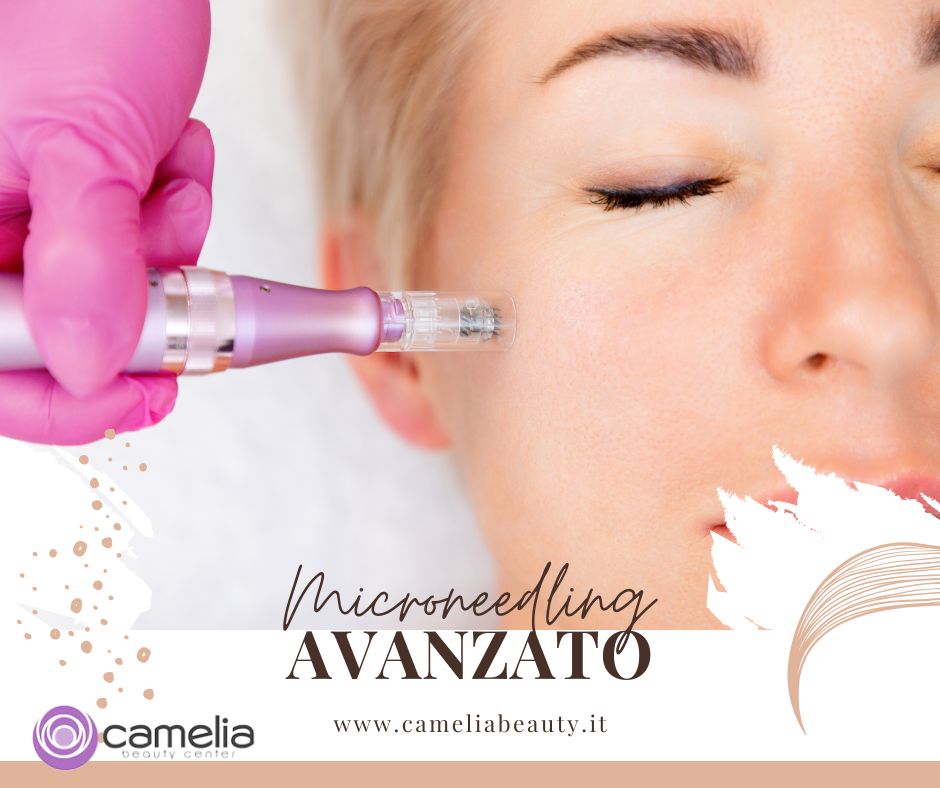 Il Microneedling Avanzato: Trattamento Rivoluzionario per una Pelle Nuova