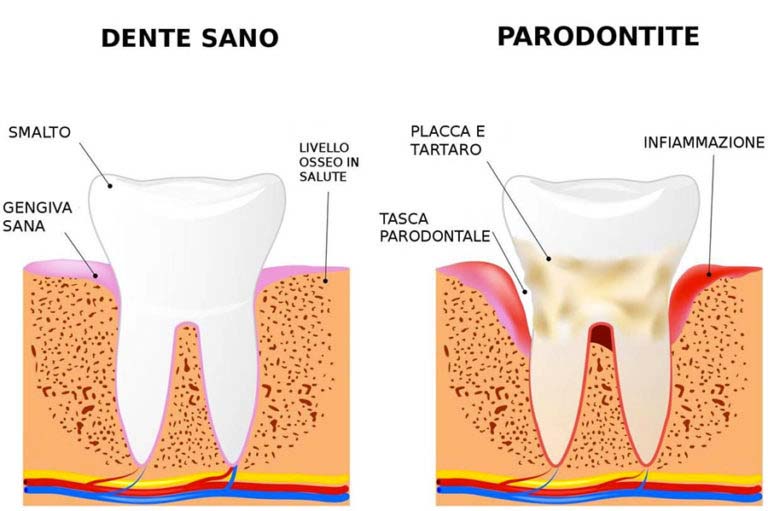 Cause E Conseguenze Della Piorrea (Parodontite)